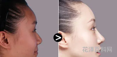 假体隆鼻好吗，取鼻假体