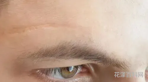 像素点阵激光，点阵激光一次多少钱