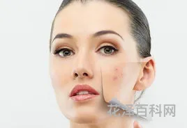 去痘坑的方法 如何去痘坑最快最有效
