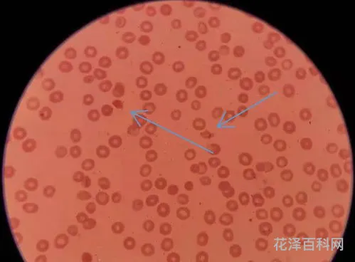 红细胞分布宽度，hscrp>5
