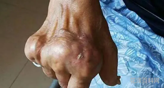 骨折的病人想要补钙