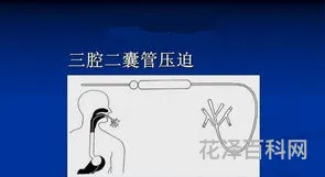 三腔二囊管止血法 三腔两囊管压迫止血时间不超过