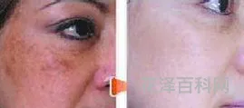 彩光祛斑效果如何 彩光祛斑美白多少钱