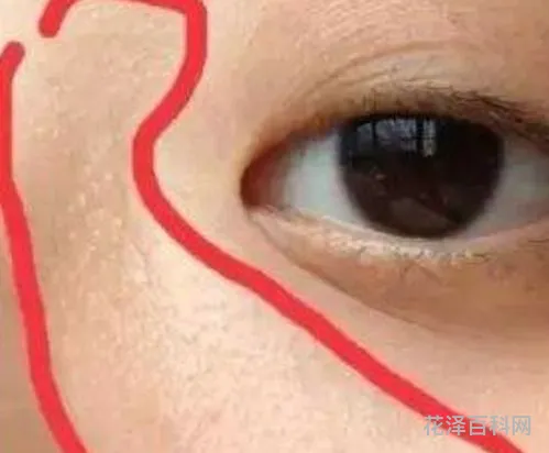 闭口长什么样子