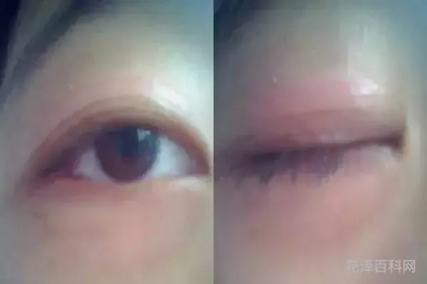 双眼皮胶水怎么洗 双眼皮胶水的正确使用方法