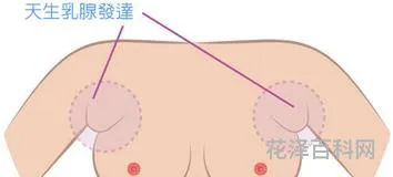 怎么消除副乳