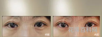 除眼袋的办法 怎么除眼袋的最好方法