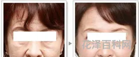 鱼尾纹去皱术，鱼尾纹除皱针打一次多少钱