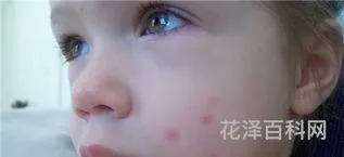 蚊子咬了怎么消肿止痒最快，蚊子咬了抹什么最管用