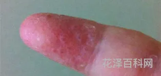 手上长小水泡，hpv水泡图片
