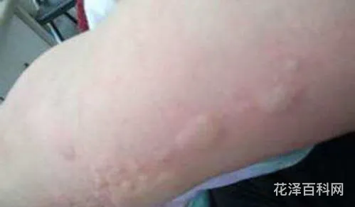 宝宝荨麻疹怎么办