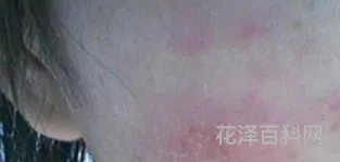 换季皮肤过敏