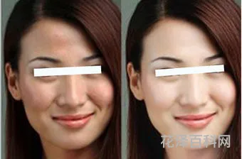 打美白针的效果，美白针去哪里打