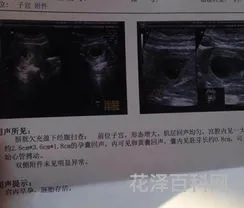 b超单看胎儿性别